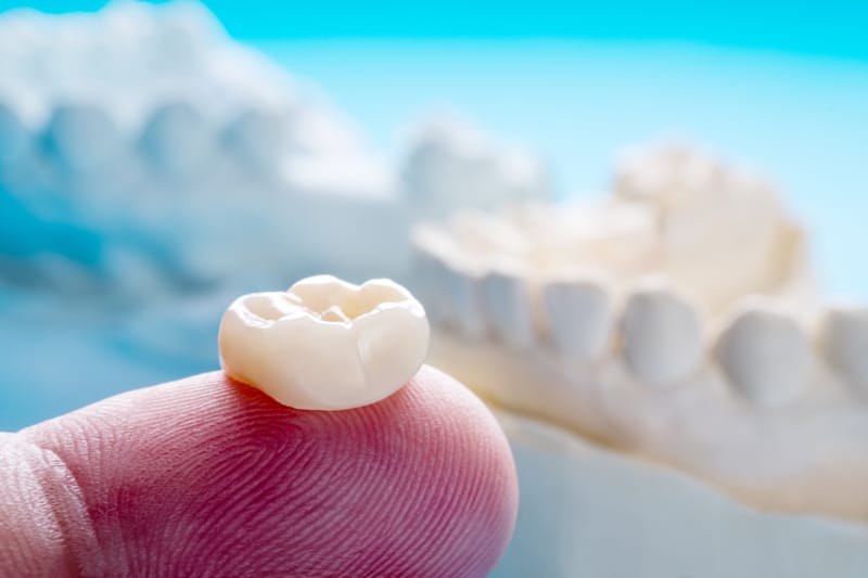 Capsula dentale rotta: cosa fare?