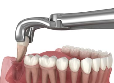 Denti del giudizio: è sempre necessario rimuoverli? Cosa dice la scienza