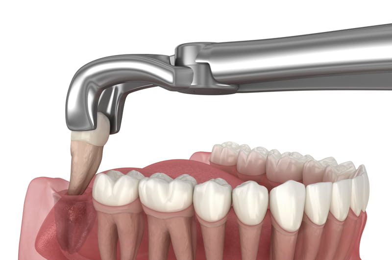 Denti del giudizio: è sempre necessario rimuoverli? Cosa dice la scienza