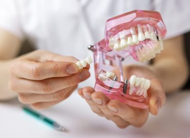 Impianti dentali: tutto ciò che devi sapere prima di sostituire i denti mancanti