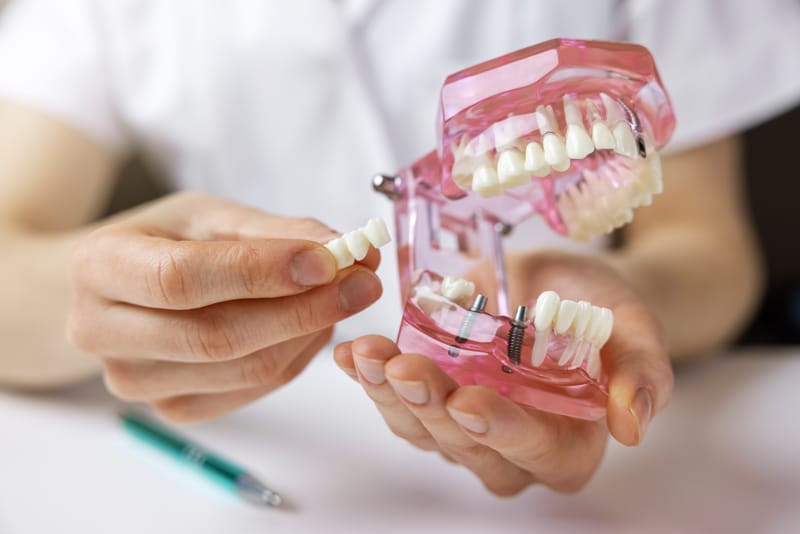 Impianti dentali: tutto ciò che devi sapere prima di sostituire i denti mancanti