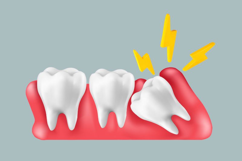 Quando i denti del giudizio spuntano solo in parte: cause, rischi e soluzioni